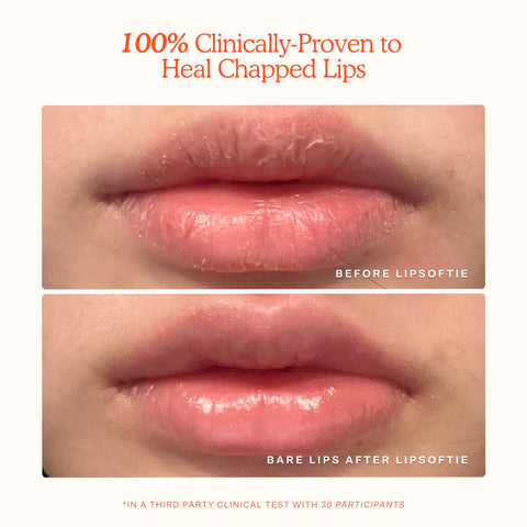 LipSoftie® Lip Treatment